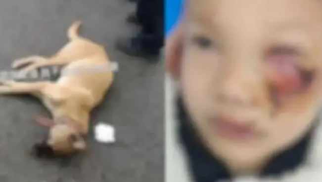 8岁男童遭狗扑咬 脸上缝了90多针！