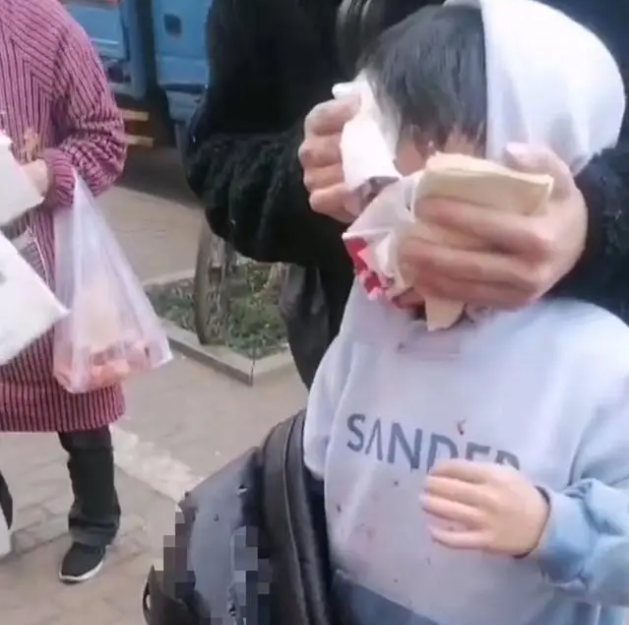 8岁男童遭狗扑咬 脸上缝了90多针