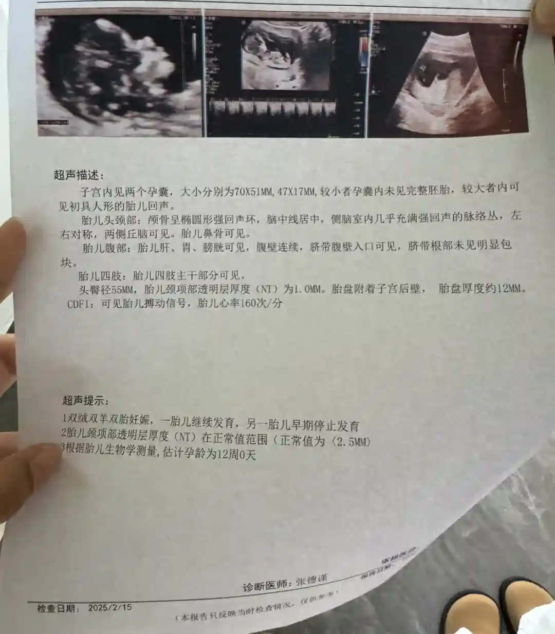 囊胚移植分裂双绒双羊胎停一个