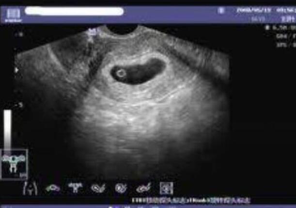 50岁做试管婴儿成功率这些因素影响成功率的高低