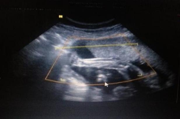 青岛试管价格表 青岛妇女儿童医院还是山大试管好?如何来选择医院? ‘b超看屁股查男女准吗’