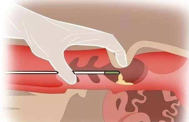 长沙湘雅医院做试管婴儿多少钱?每一代花销都不同