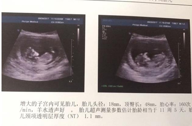 男性少精弱精患者试管婴儿成功率并不是100%怀孕