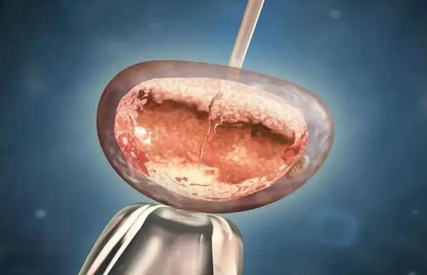 试管婴儿有什么风险？揭秘试管婴儿流程