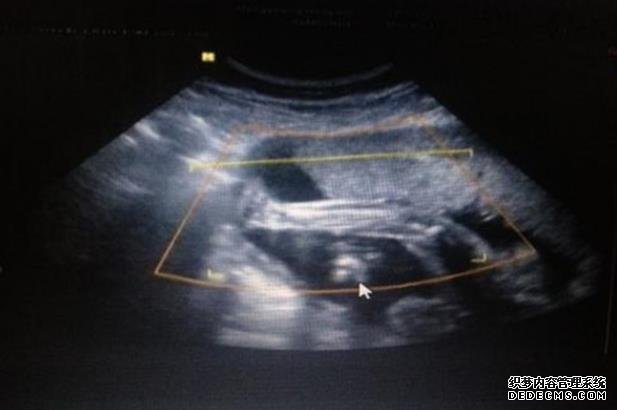 北京能做试管医院有几家 北京妇产医院待产包 ‘三维B超数据怎么看男女’