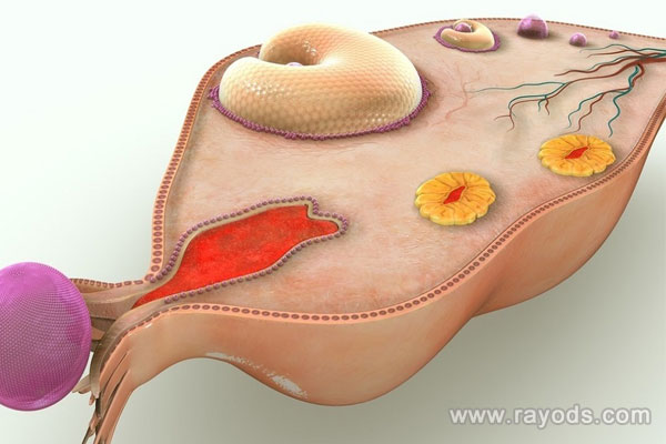 巧克力囊肿会导致不孕